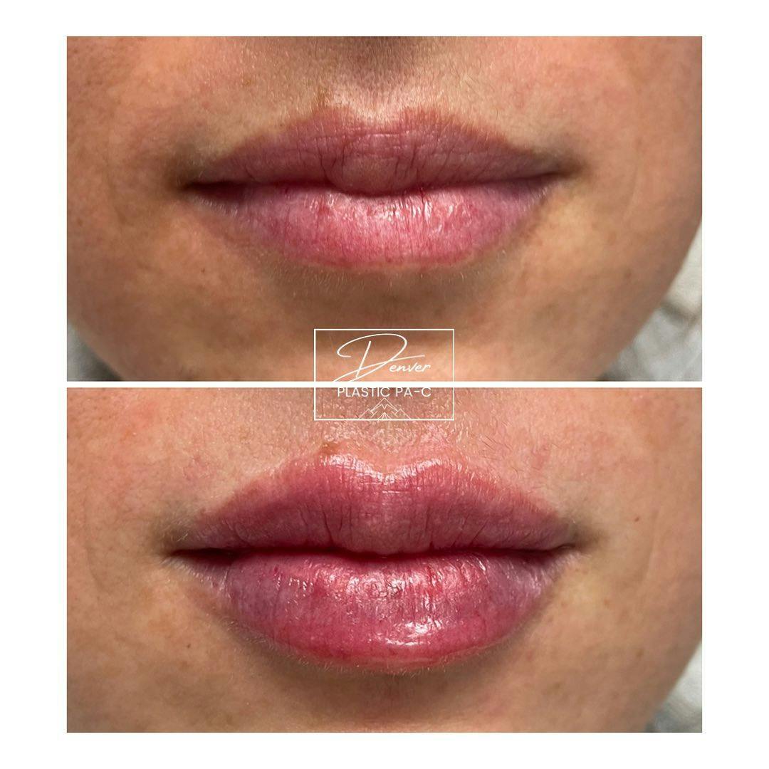 Lip Fillers Before & After Gallery - Patient 60754599 - Image 2