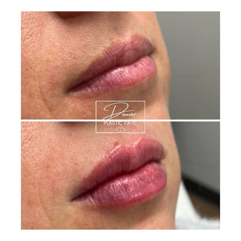 Lip Fillers Before & After Gallery - Patient 60754599 - Image 1