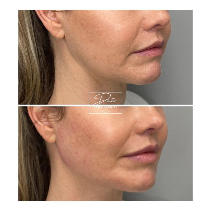 Jawline Sculpting Before & After Gallery - Patient 60754602 - Image 1