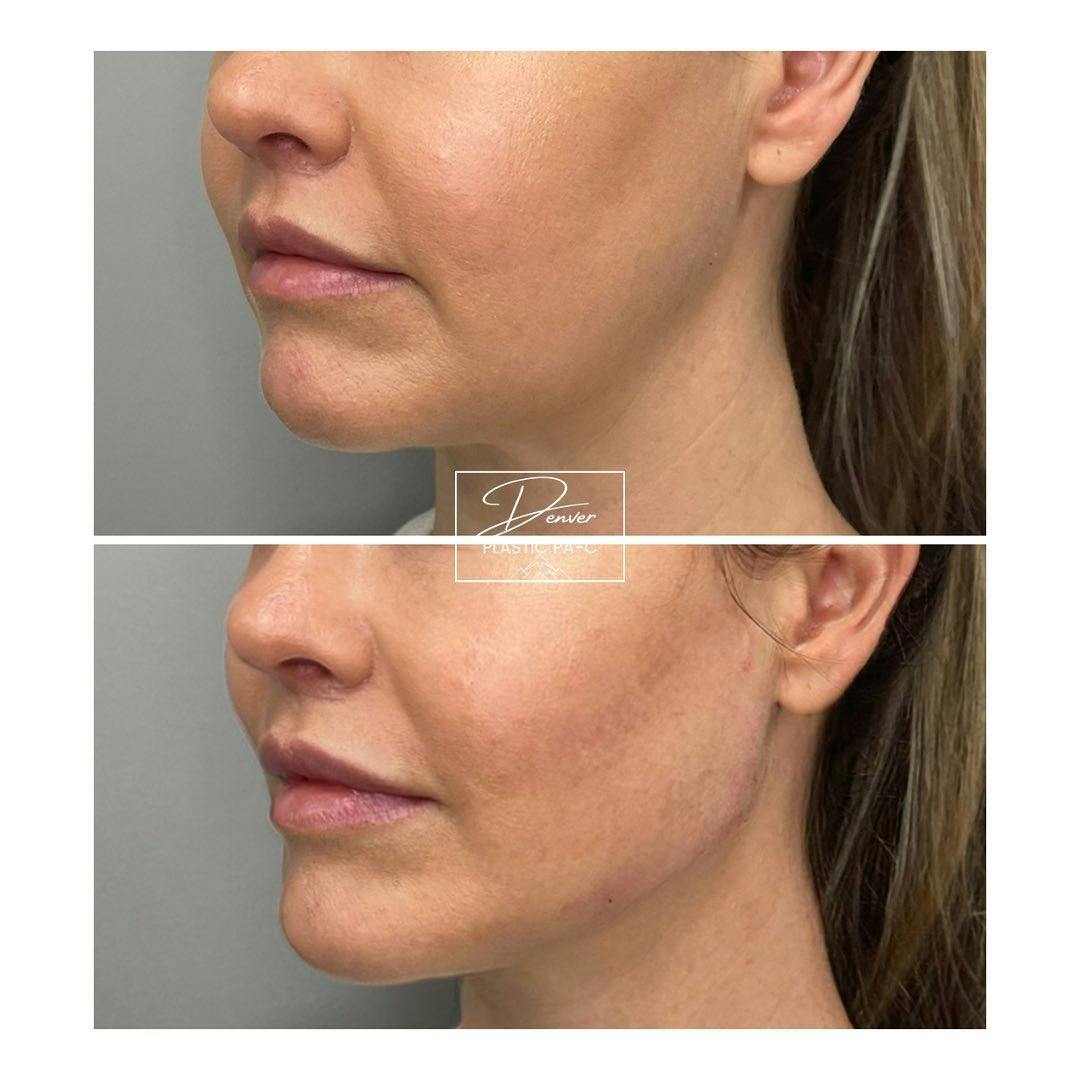 Jawline Sculpting Before & After Gallery - Patient 60754602 - Image 2