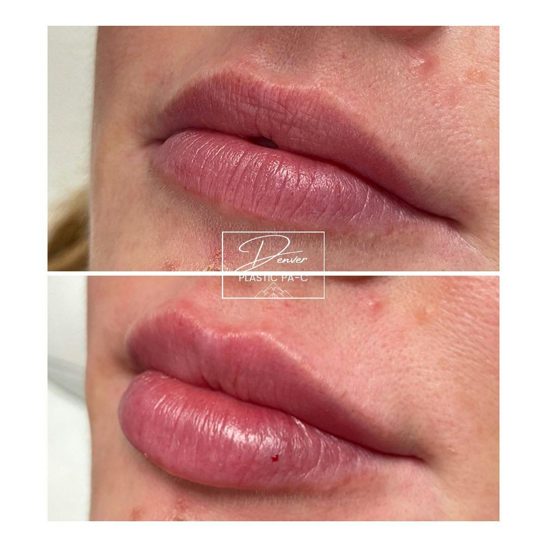 Lip Fillers Before & After Gallery - Patient 60754616 - Image 2
