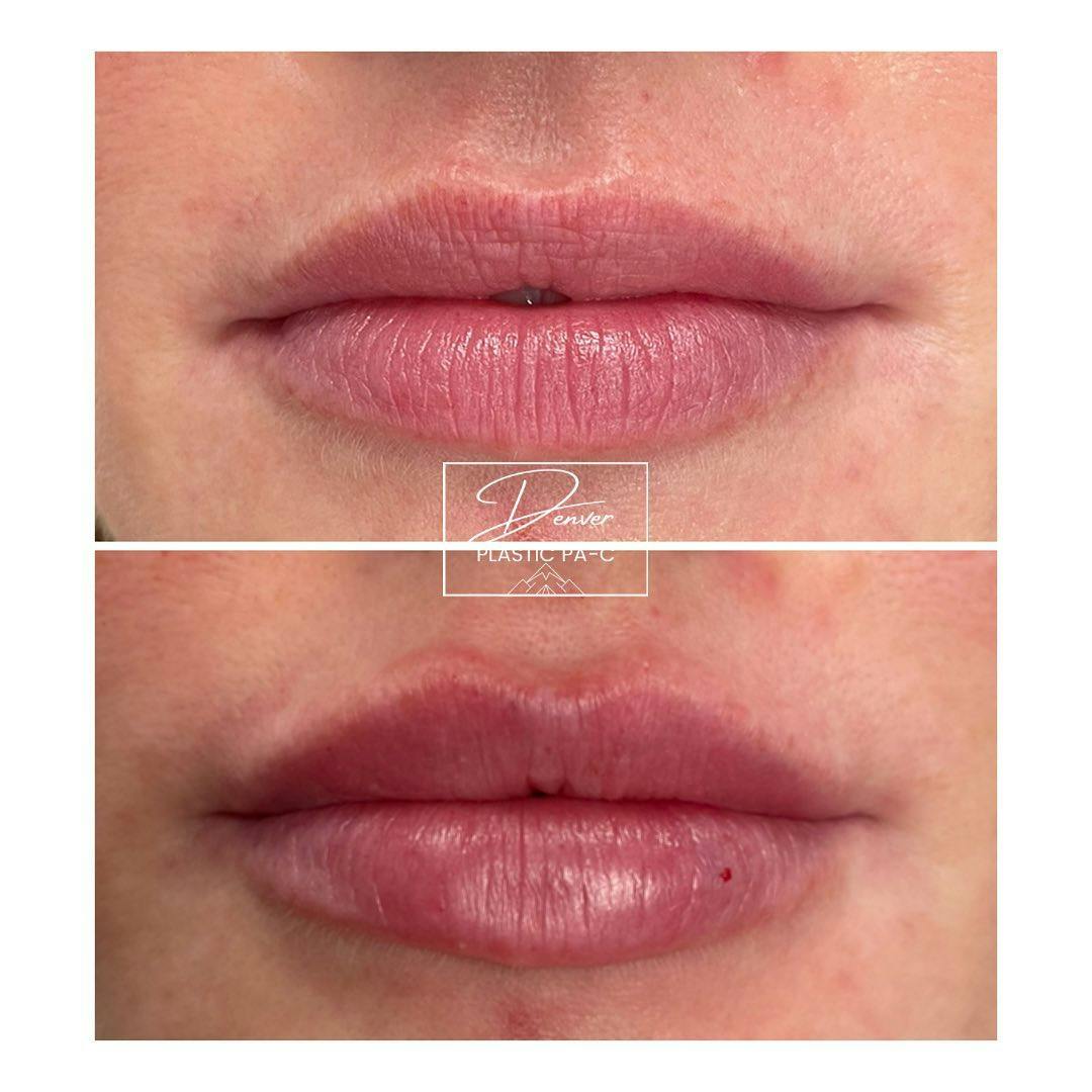Lip Fillers Before & After Gallery - Patient 60754616 - Image 3