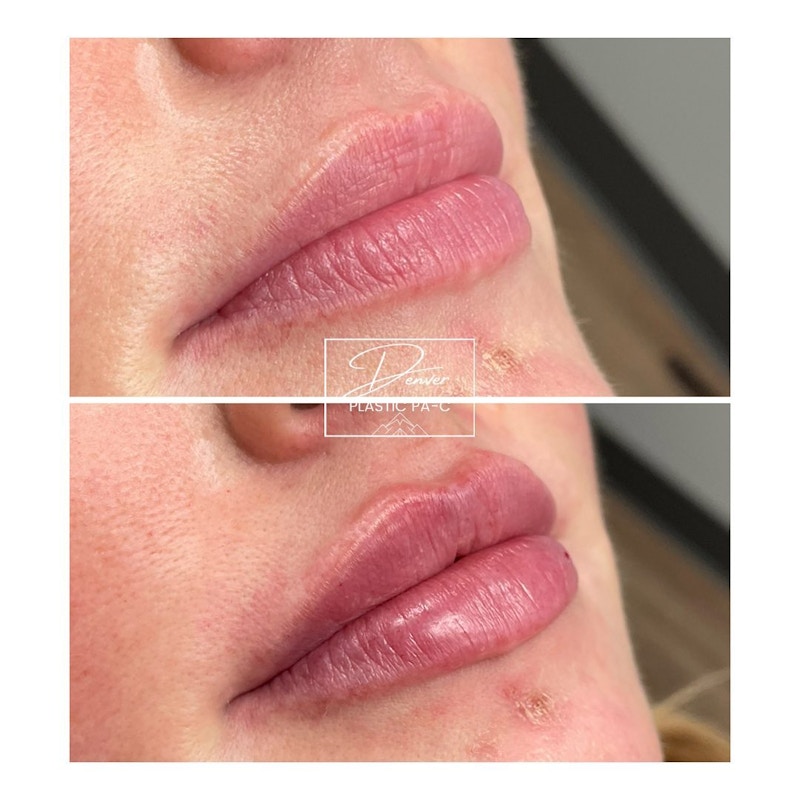 Lip Fillers Before & After Gallery - Patient 60754616 - Image 1