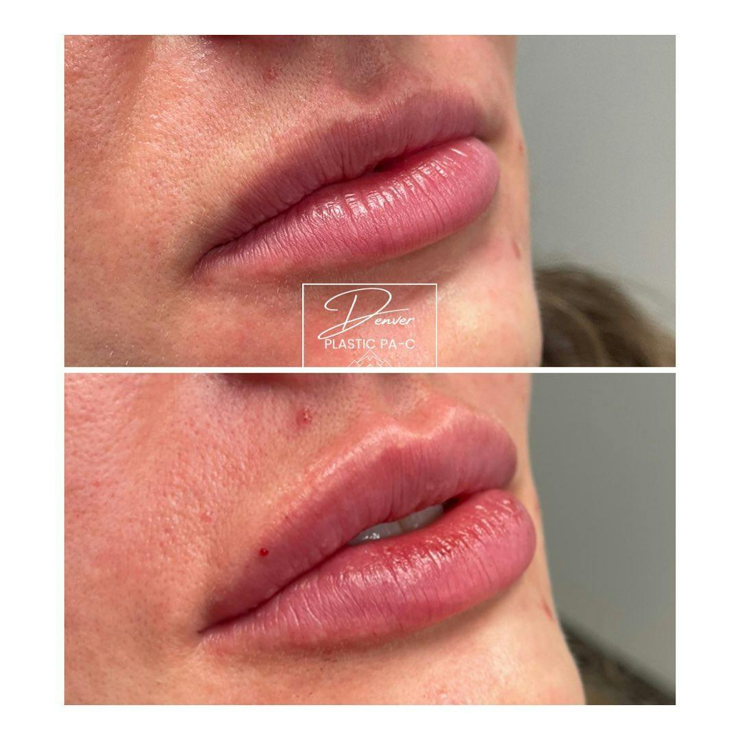 Lip Fillers Before & After Gallery - Patient 60754630 - Image 1