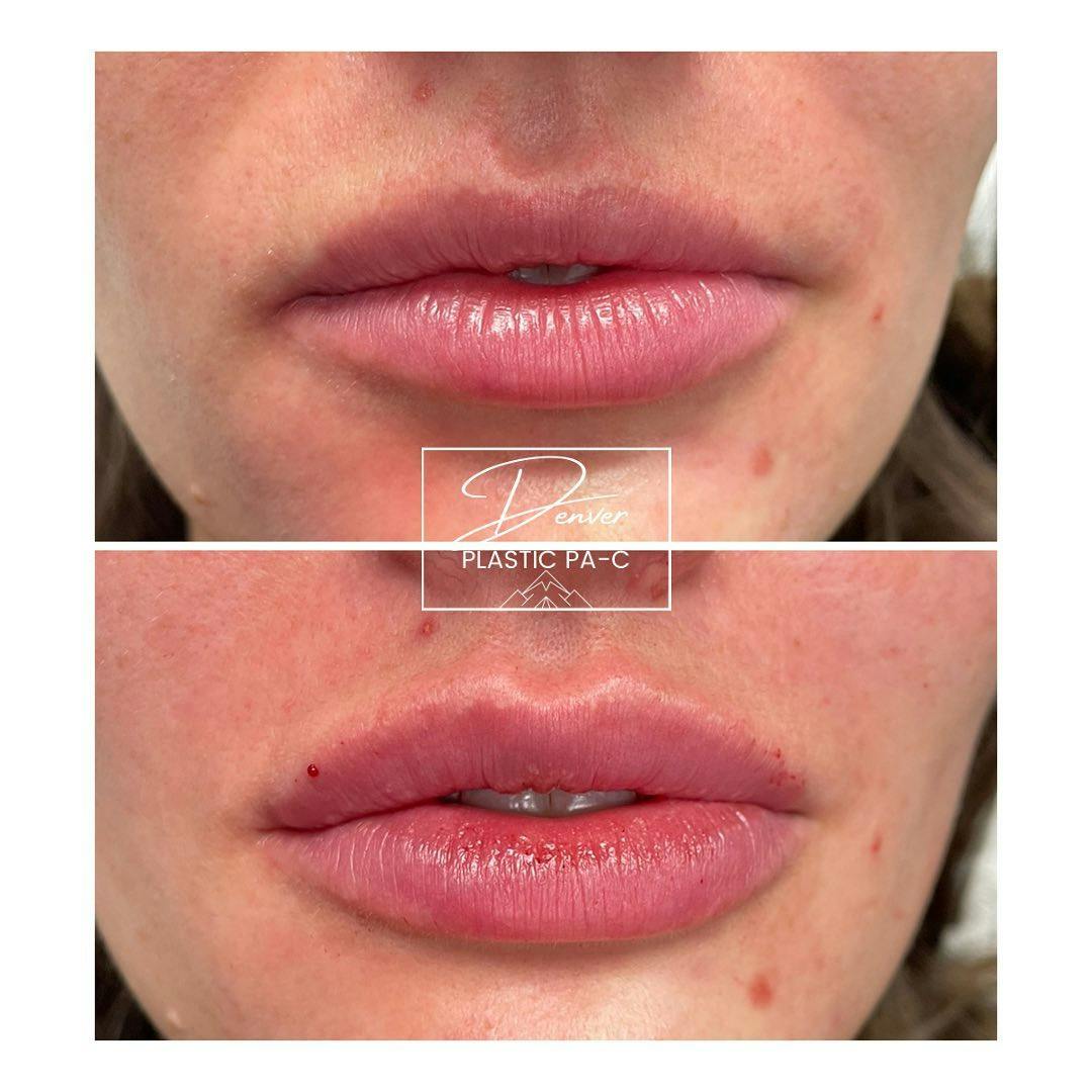 Lip Fillers Before & After Gallery - Patient 60754630 - Image 2