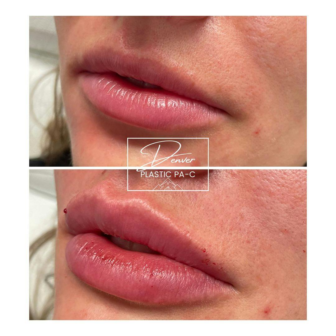Lip Fillers Before & After Gallery - Patient 60754630 - Image 3