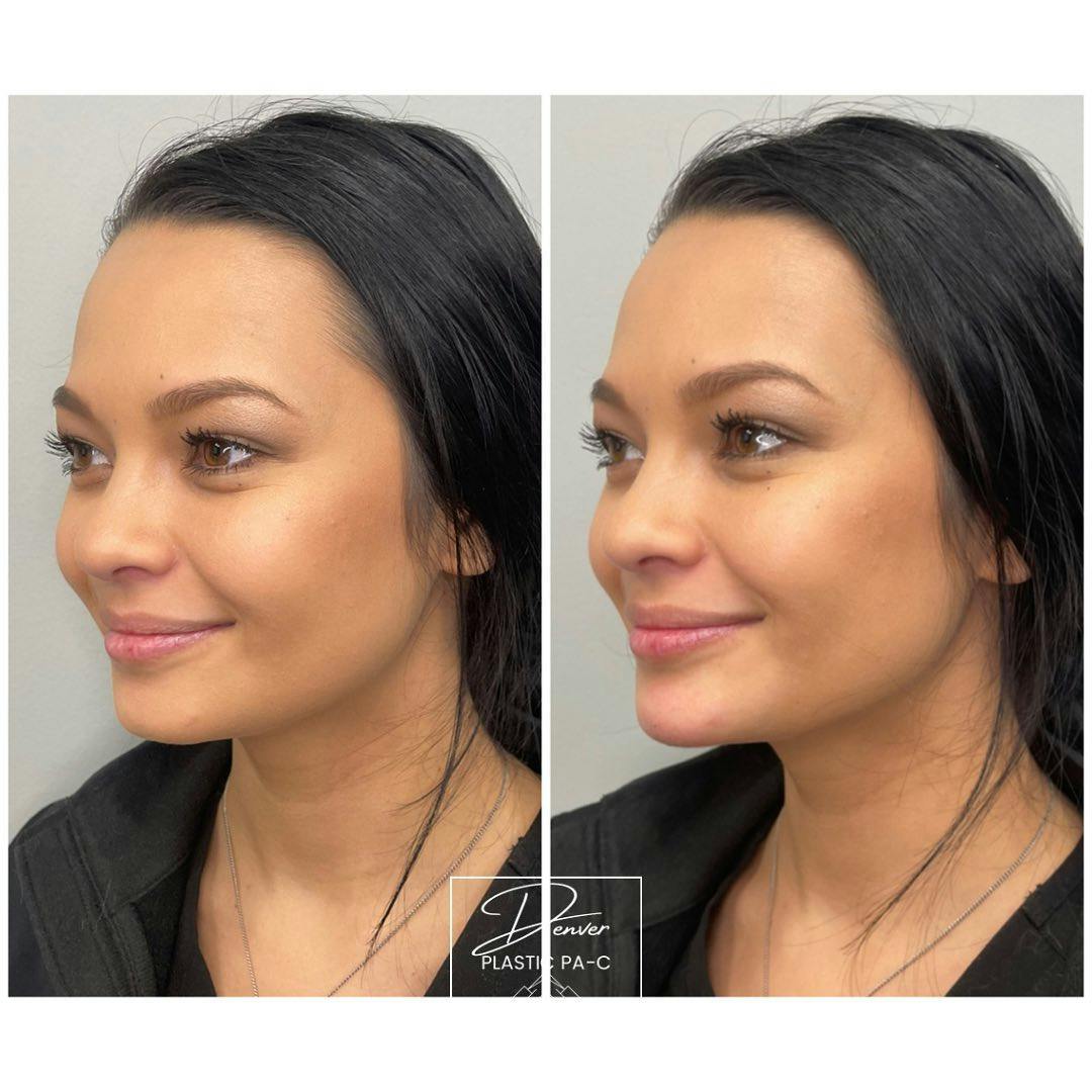 Jawline Sculpting Before & After Gallery - Patient 60754697 - Image 2