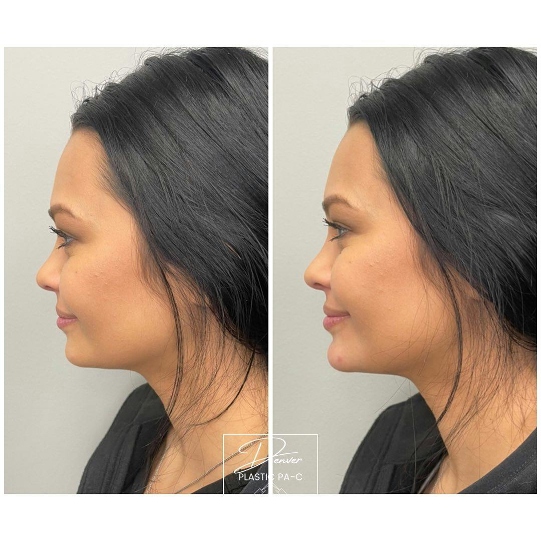 Jawline Sculpting Before & After Gallery - Patient 60754697 - Image 3
