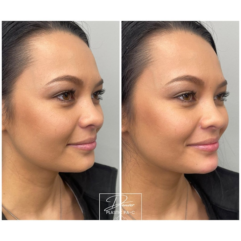 Jawline Sculpting Before & After Gallery - Patient 60754697 - Image 1