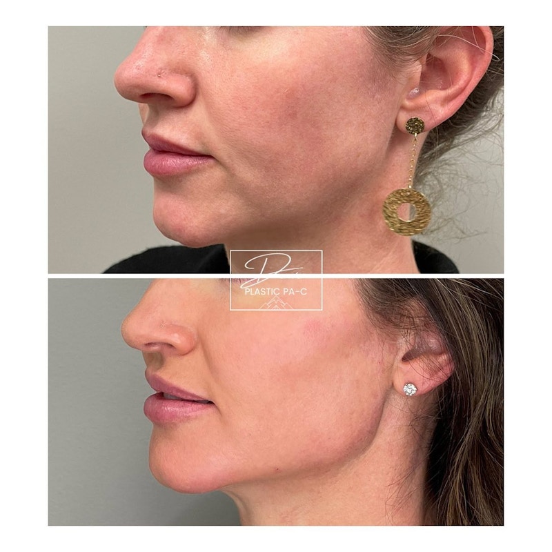 Jawline Sculpting Before & After Gallery - Patient 60754713 - Image 1