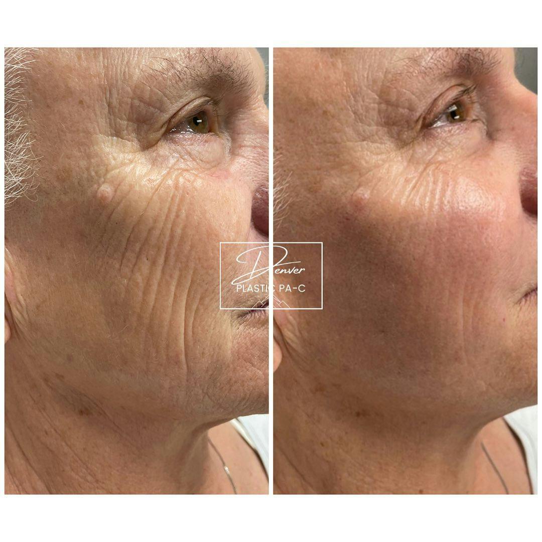 RHA® Fillers Before & After Gallery - Patient 60754721 - Image 1