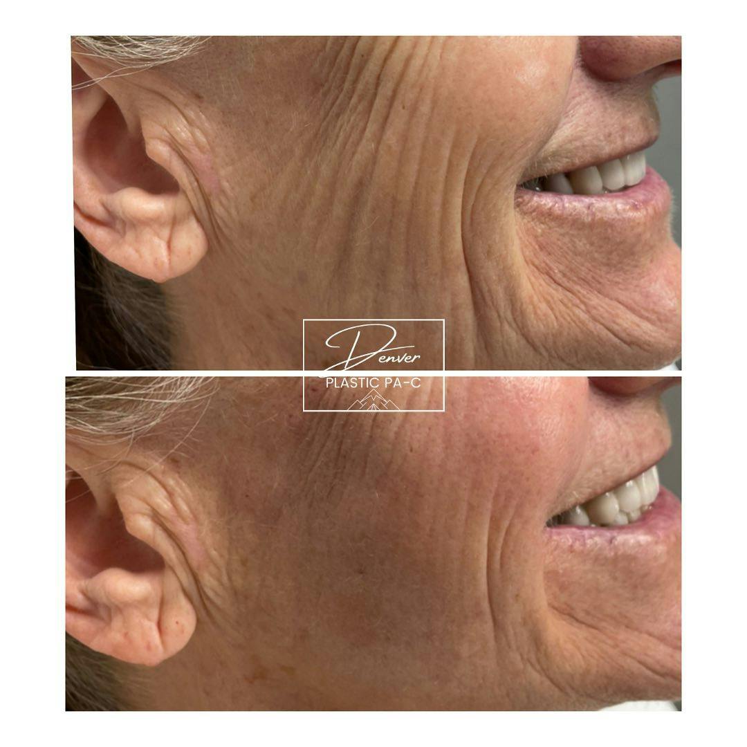 RHA Fillers Before & After Gallery - Patient 60754721 - Image 2