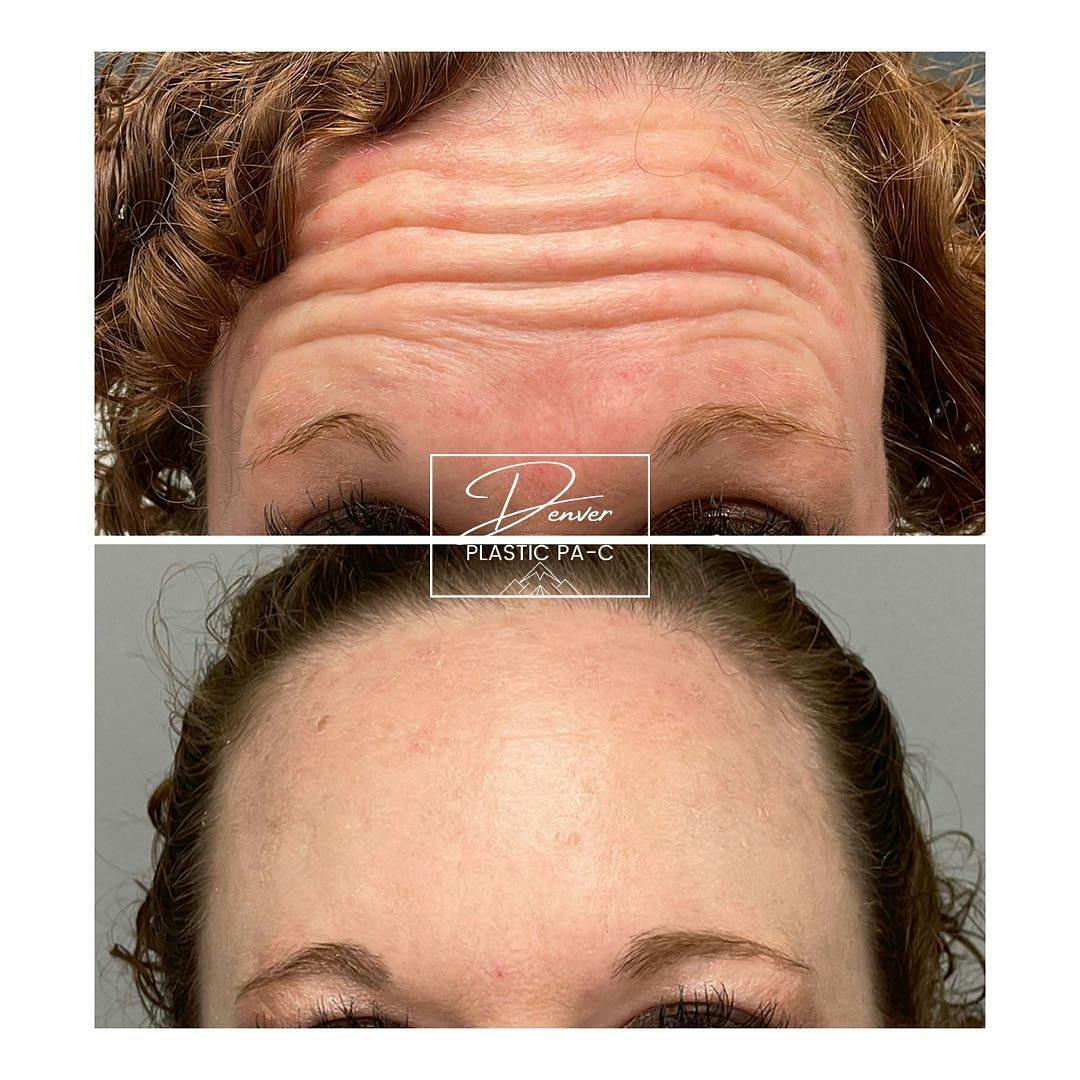 BOTOX®/Dysport Before & After Gallery - Patient 60762969 - Image 1