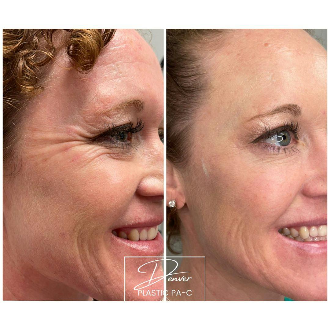 BOTOX/Dysport Before & After Gallery - Patient 60762969 - Image 2