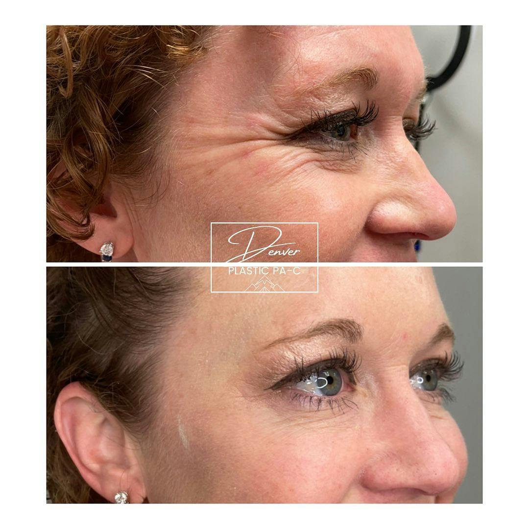 BOTOX®/Dysport Before & After Gallery - Patient 60762969 - Image 3