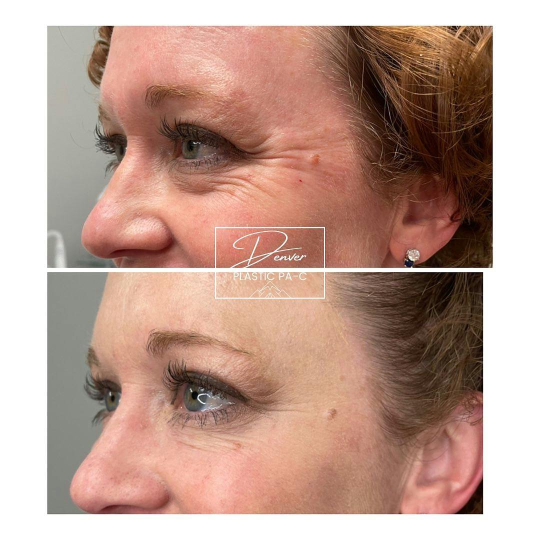 BOTOX®/Dysport Before & After Gallery - Patient 60762969 - Image 4