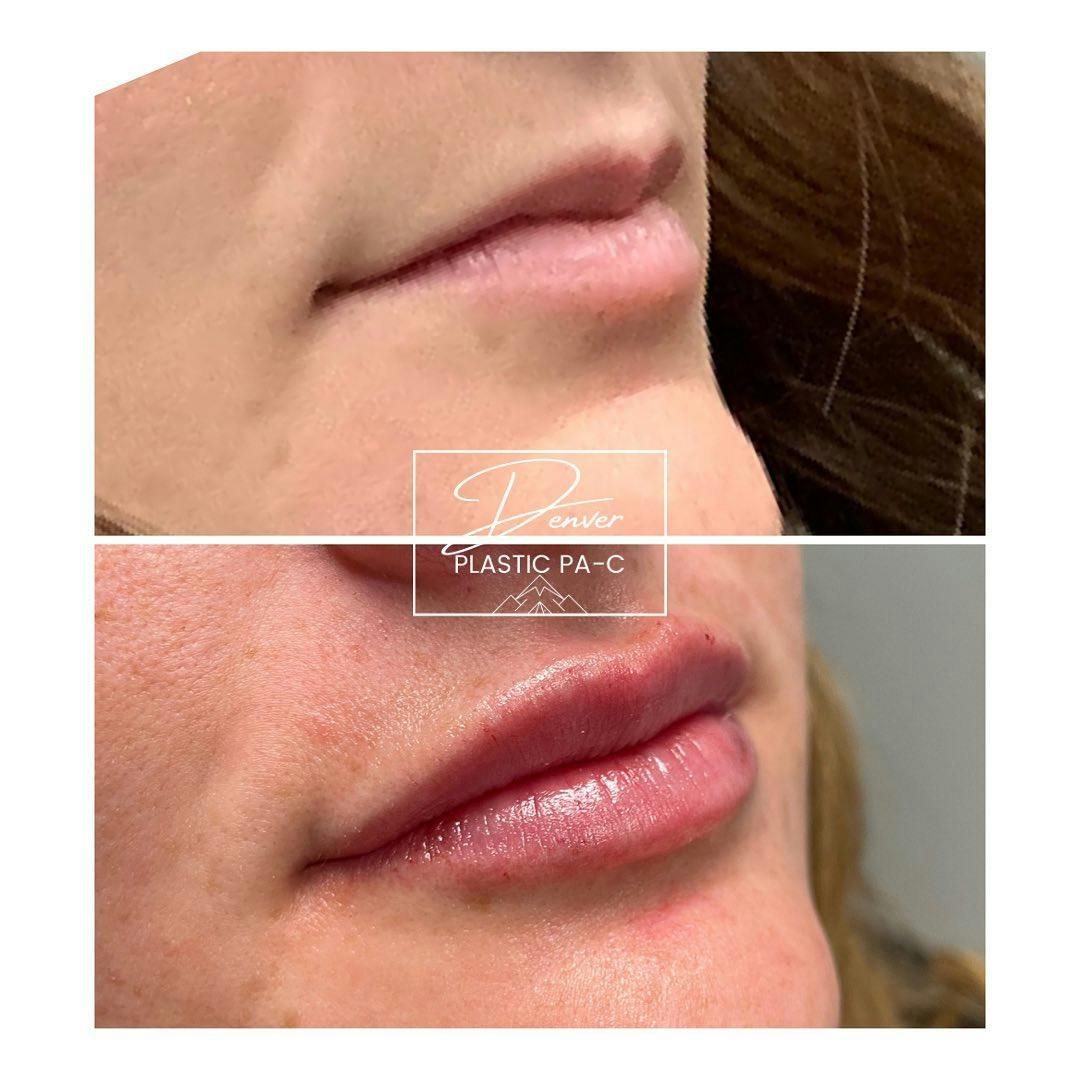 Lip Fillers Before & After Gallery - Patient 60762978 - Image 1