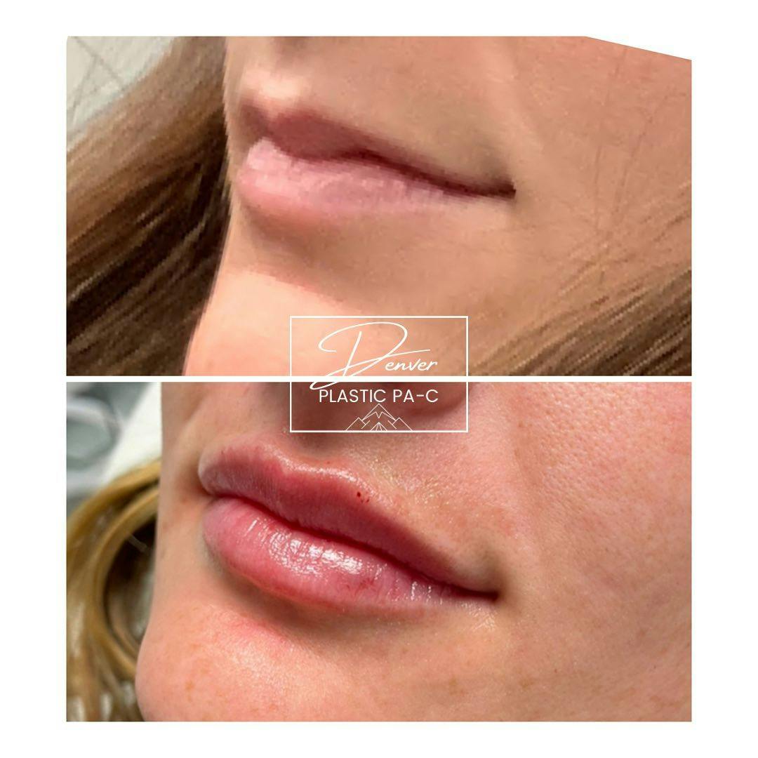 Lip Fillers Before & After Gallery - Patient 60762978 - Image 2