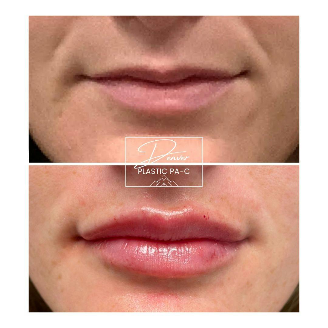 Lip Fillers Before & After Gallery - Patient 60762978 - Image 3
