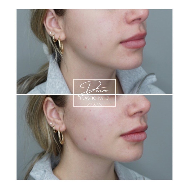 Jawline Sculpting Before & After Gallery - Patient 60762981 - Image 1