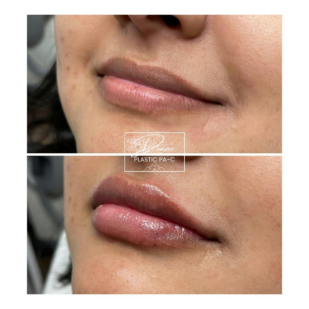 Lip Fillers Before & After Gallery - Patient 60779162 - Image 2