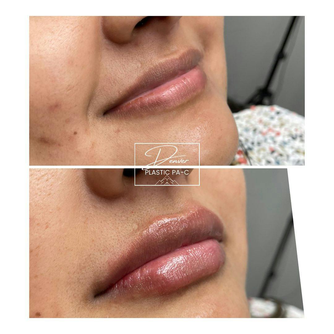 Lip Fillers Before & After Gallery - Patient 60779162 - Image 1
