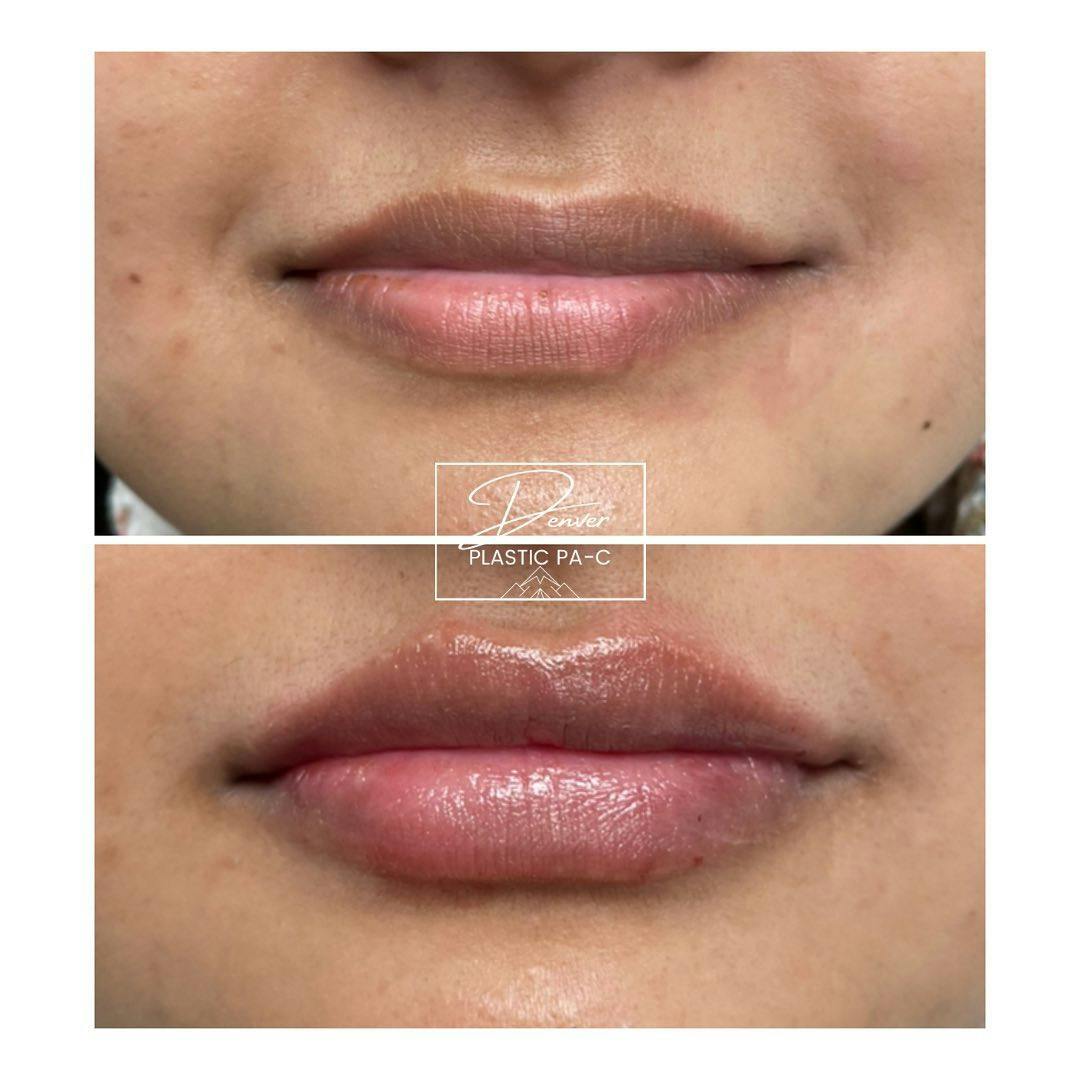 Lip Fillers Before & After Gallery - Patient 60779162 - Image 3