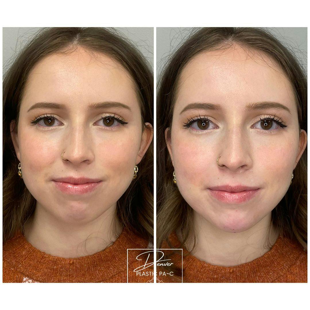 BOTOX®/Dysport Before & After Gallery - Patient 60779166 - Image 2