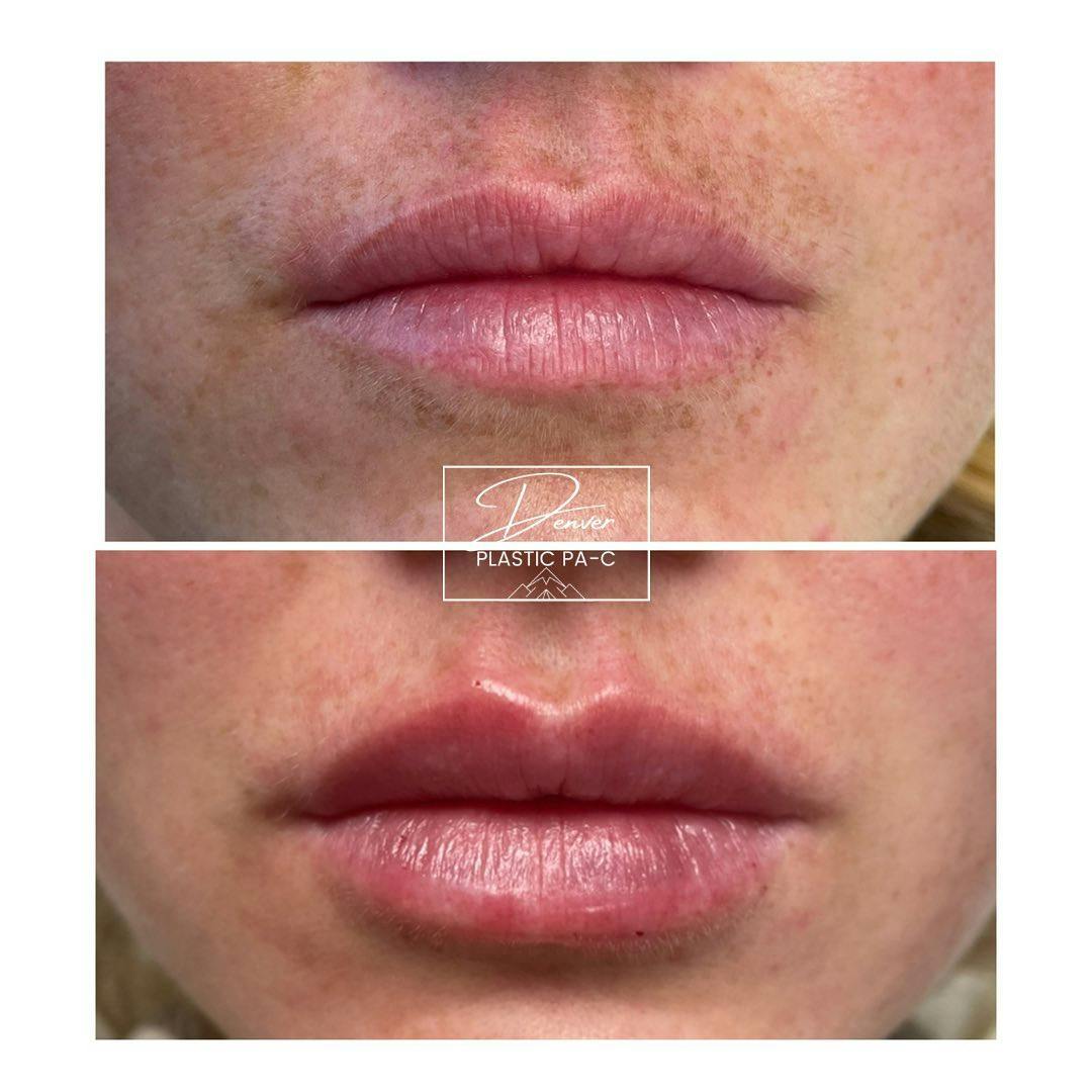 Lip Fillers Before & After Gallery - Patient 60779168 - Image 2