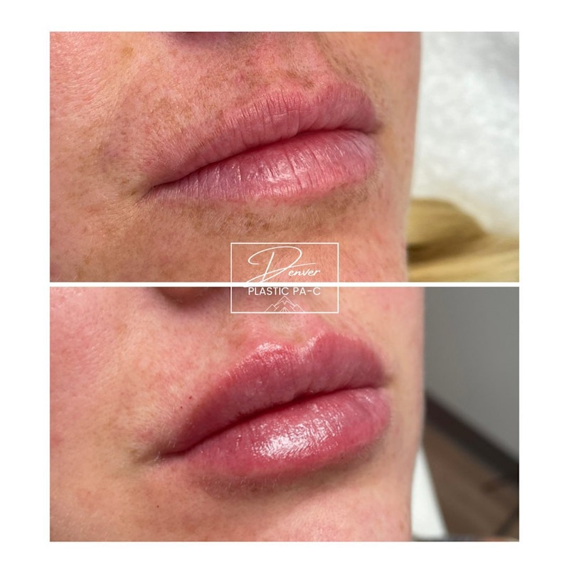 Lip Fillers Before & After Gallery - Patient 60779168 - Image 1