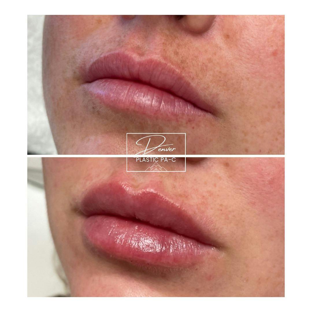 Lip Fillers Before & After Gallery - Patient 60779168 - Image 3