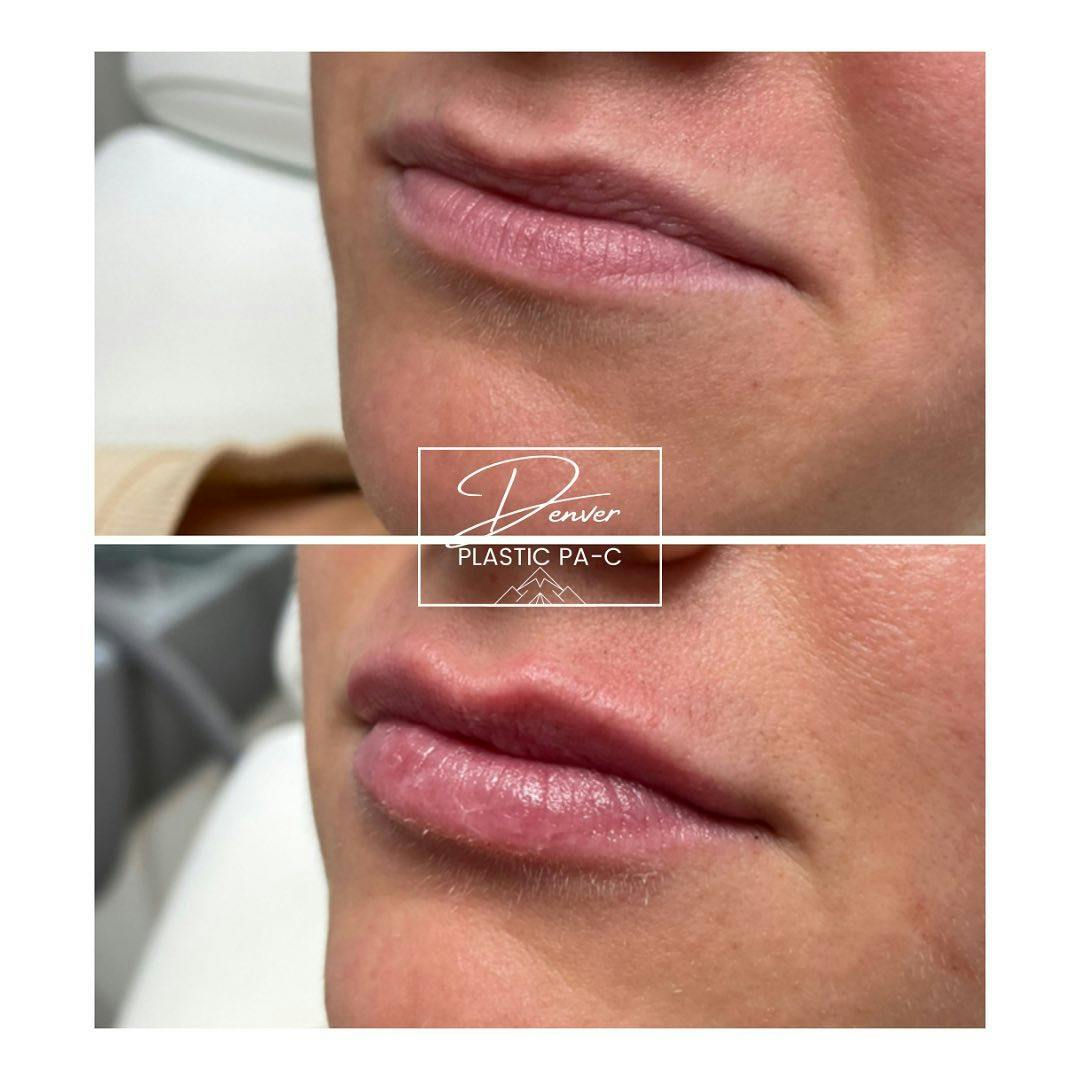 Lip Fillers Before & After Gallery - Patient 60779174 - Image 2