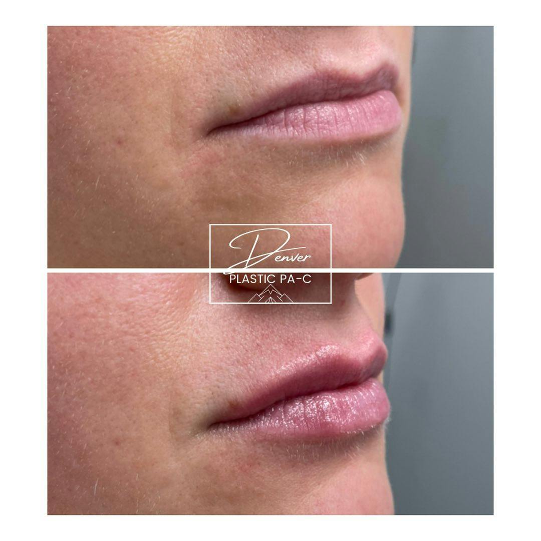 Lip Fillers Before & After Gallery - Patient 60779174 - Image 1