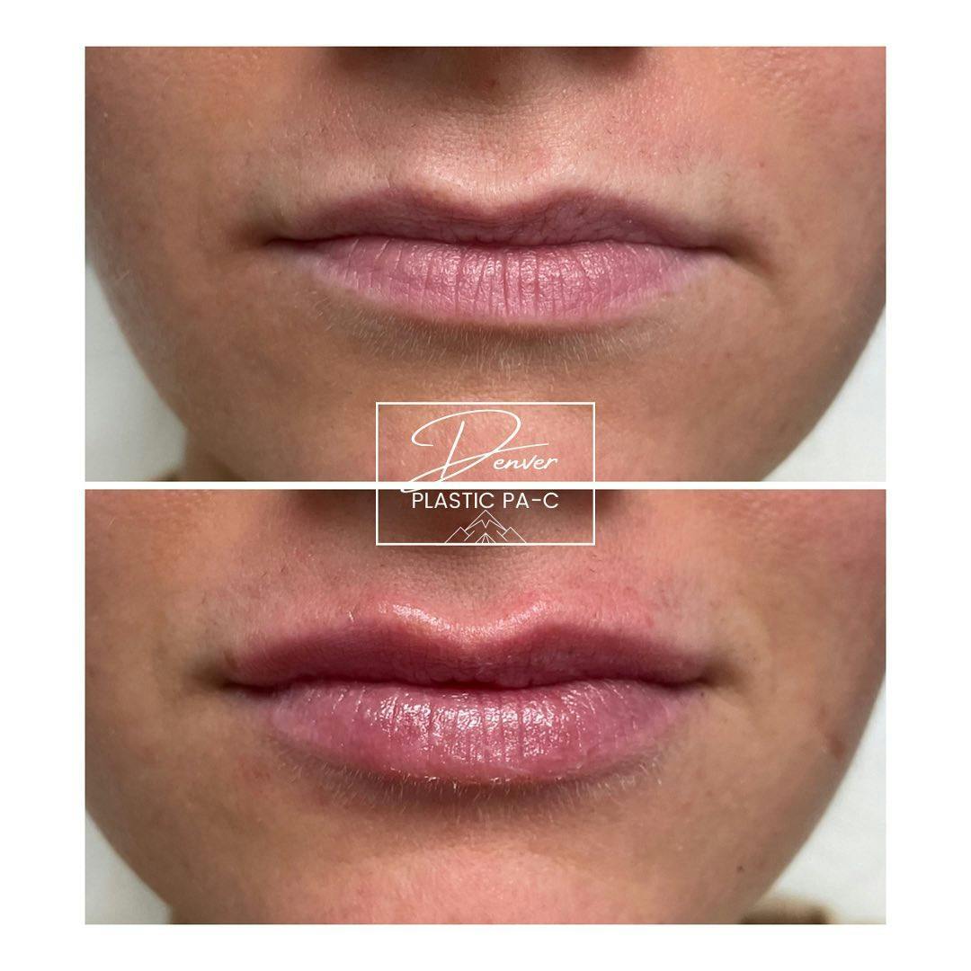 Lip Fillers Before & After Gallery - Patient 60779174 - Image 3