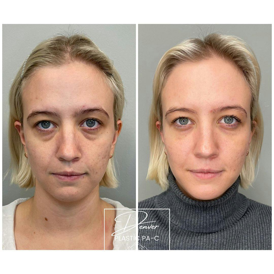 Under Eye Filler Before & After Gallery - Patient 163263036 - Image 1