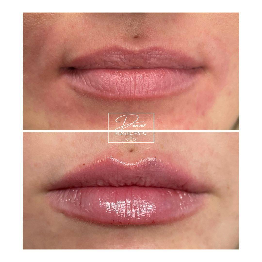 Lip Fillers Before & After Gallery - Patient 60779185 - Image 2