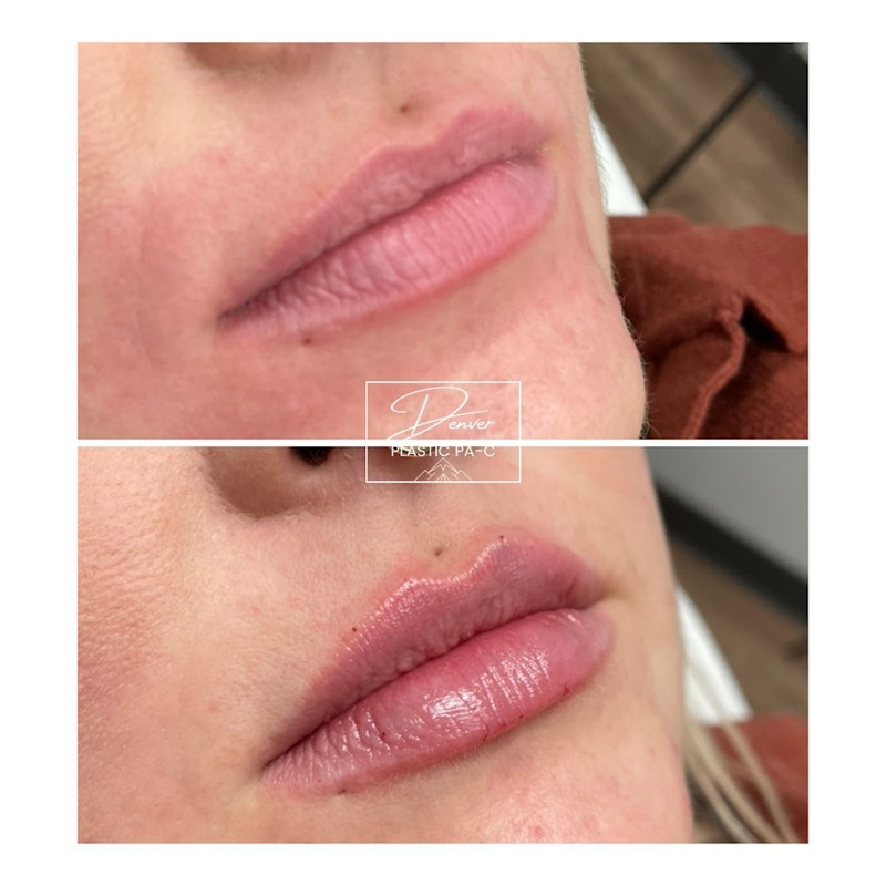 Lip Fillers Before & After Gallery - Patient 60779185 - Image 1