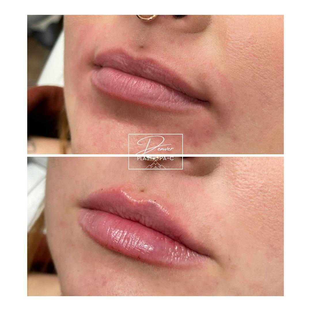 Lip Fillers Before & After Gallery - Patient 60779185 - Image 3