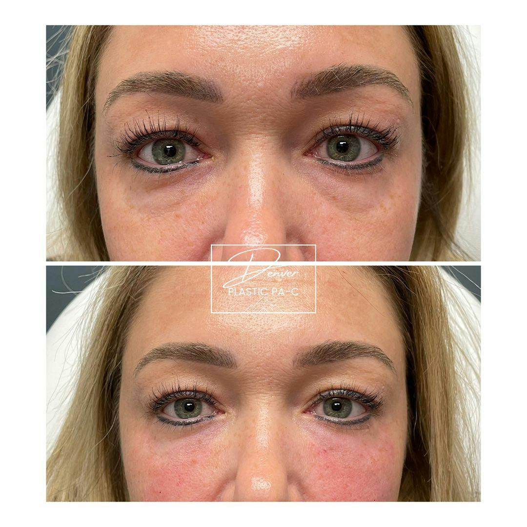 Under Eye Filler Before & After Gallery - Patient 163263038 - Image 1