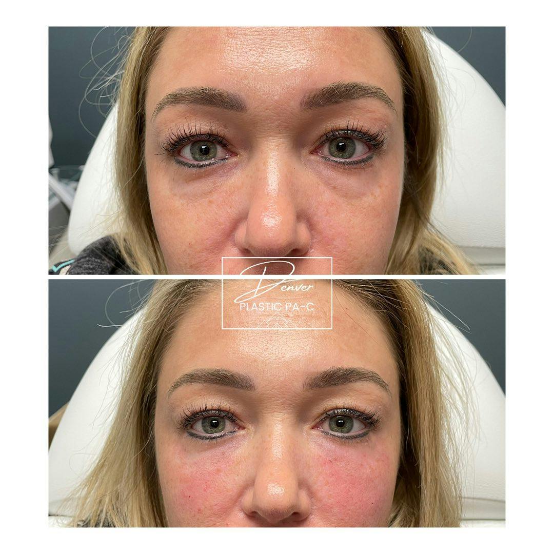 Under Eye Filler Before & After Gallery - Patient 163263038 - Image 2