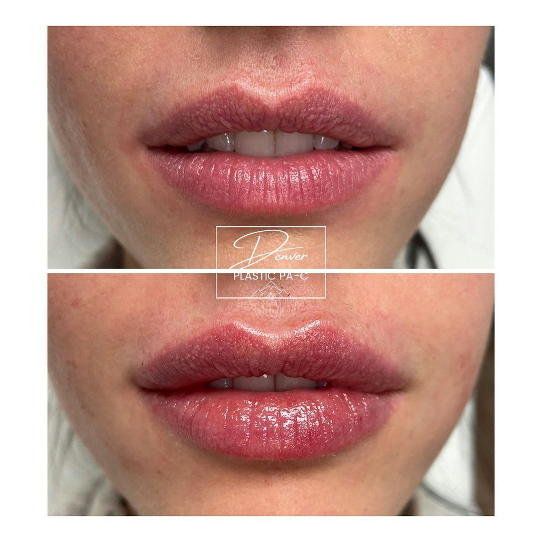 Lip Fillers Before & After Gallery - Patient 60780816 - Image 2