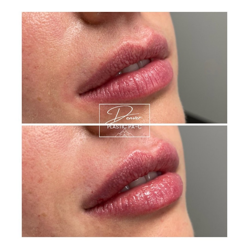 Lip Fillers Before & After Gallery - Patient 60780816 - Image 1