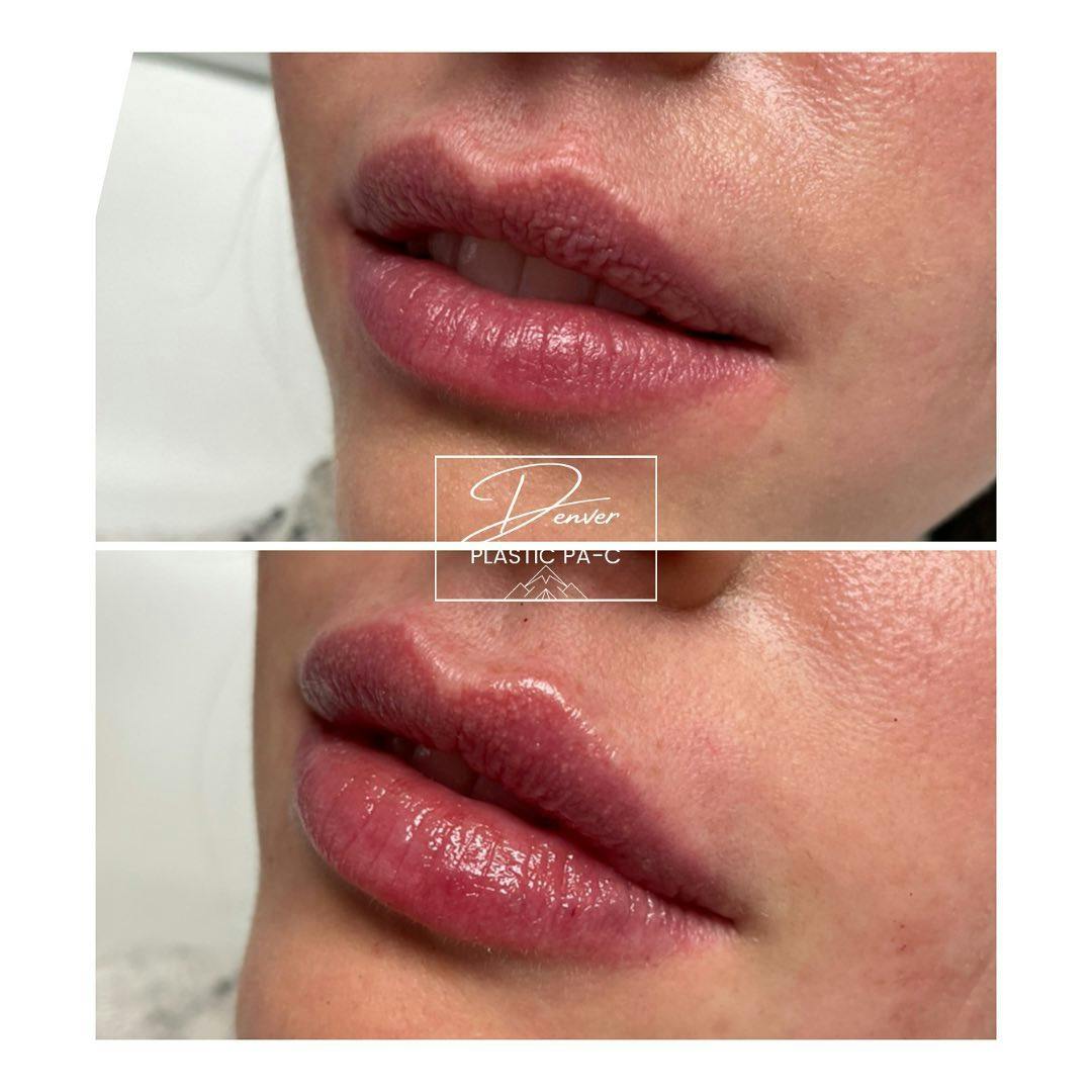 Lip Fillers Before & After Gallery - Patient 60780816 - Image 3