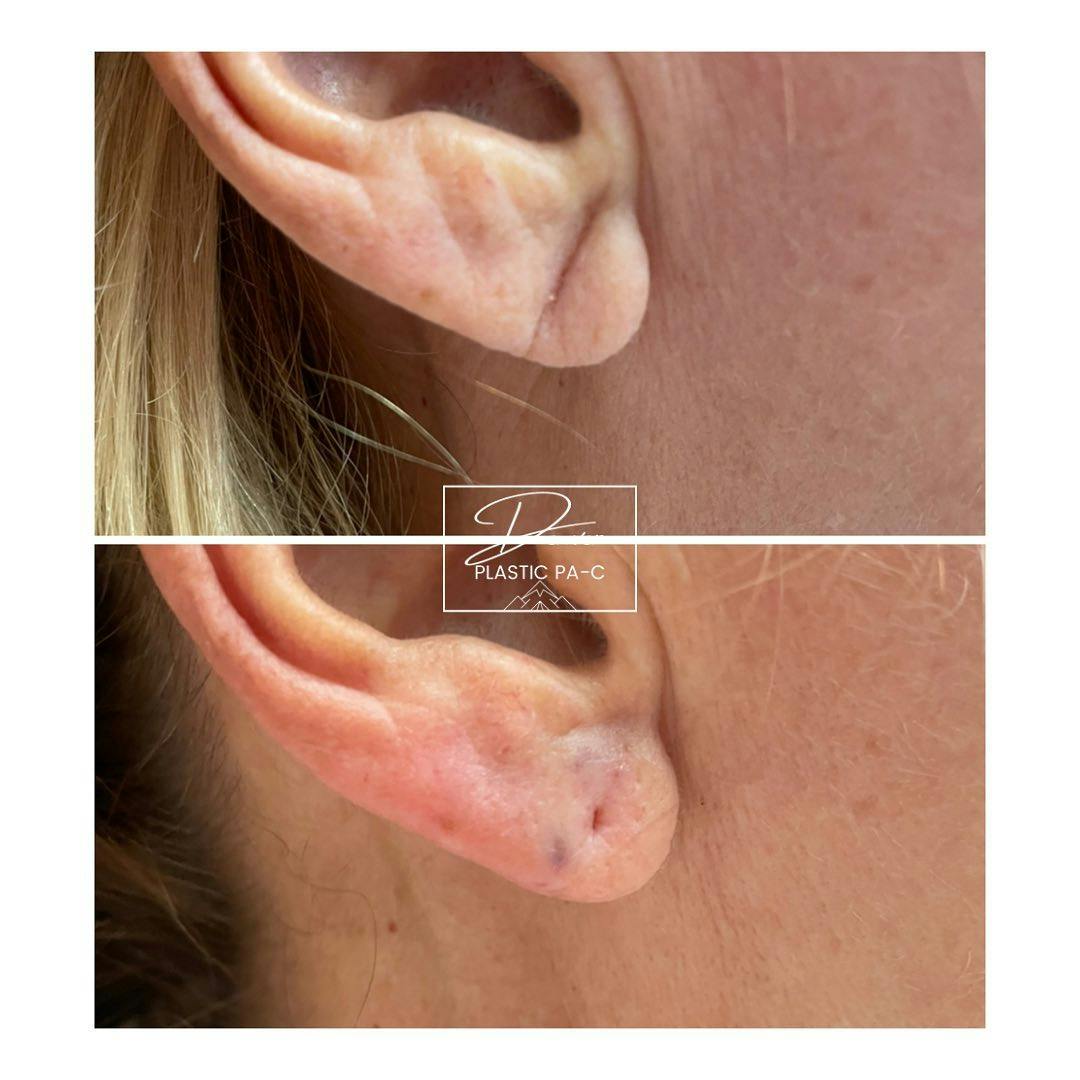 Earlobe Repair Before & After Gallery - Patient 60780823 - Image 1