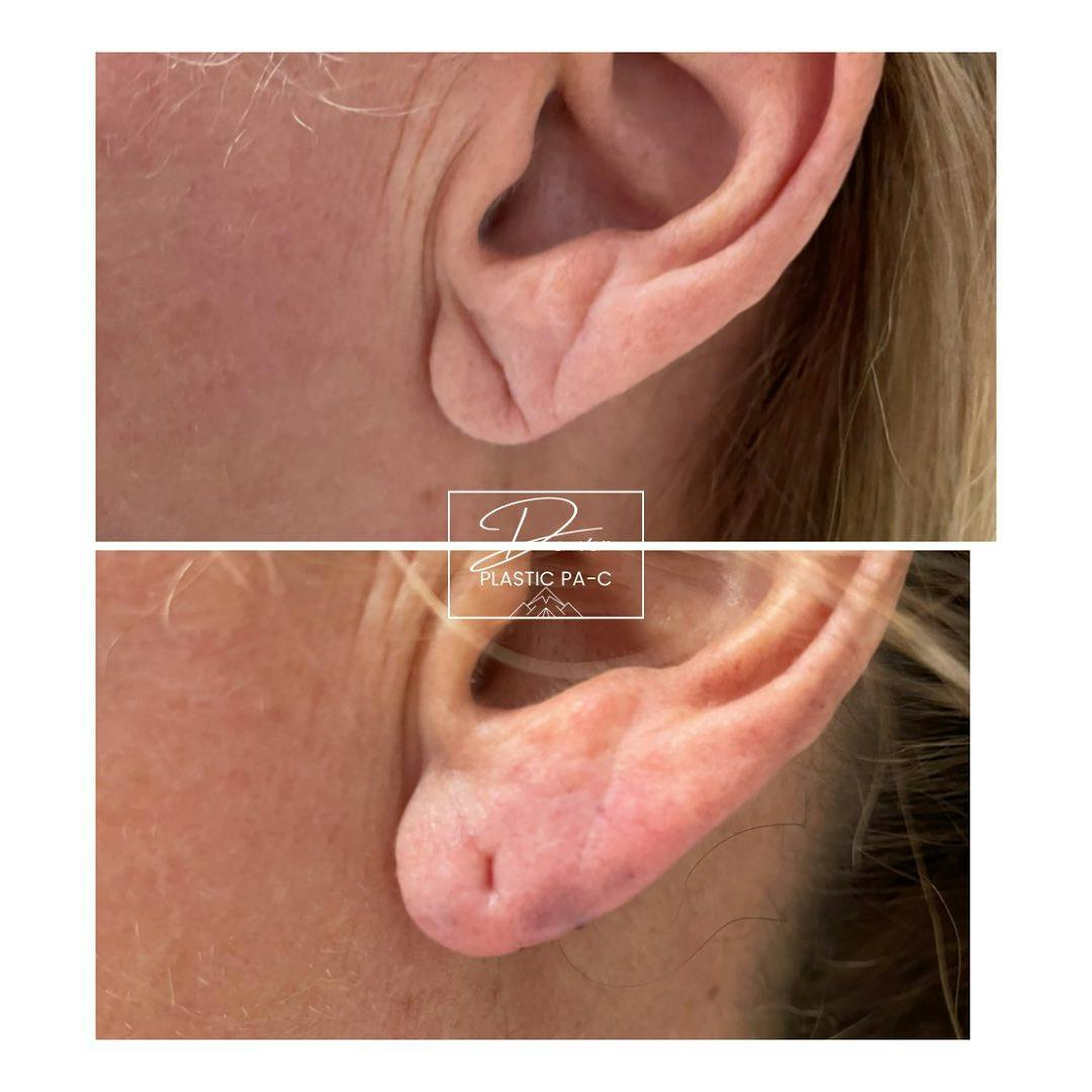 Earlobe Repair Before & After Gallery - Patient 60780823 - Image 2