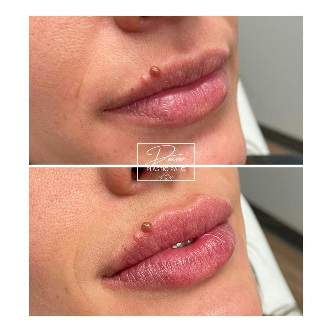 Lip Fillers Before & After Gallery - Patient 60780827 - Image 1