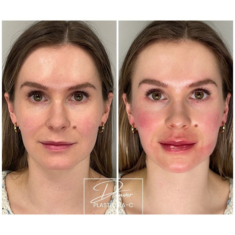 Facial Rejuvenation Before & After Gallery - Patient 60780833 - Image 1