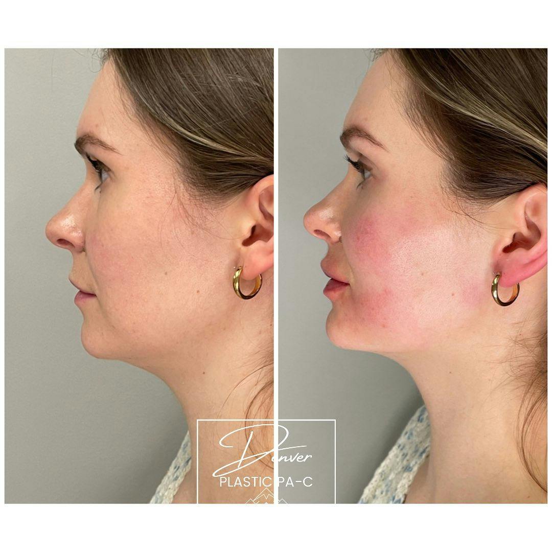 Jawline Sculpting Before & After Gallery - Patient 60780835 - Image 3