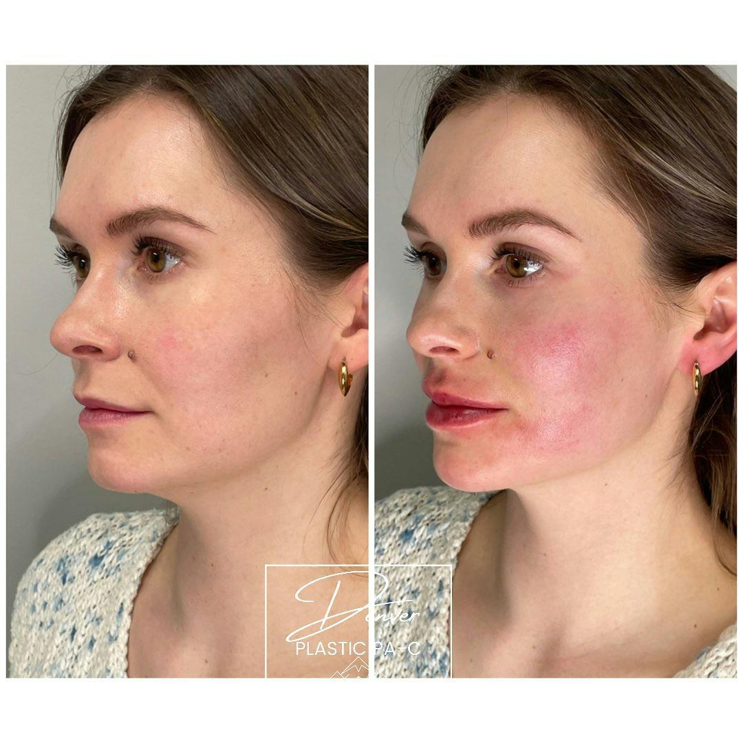Jawline Sculpting Before & After Gallery - Patient 60780835 - Image 4