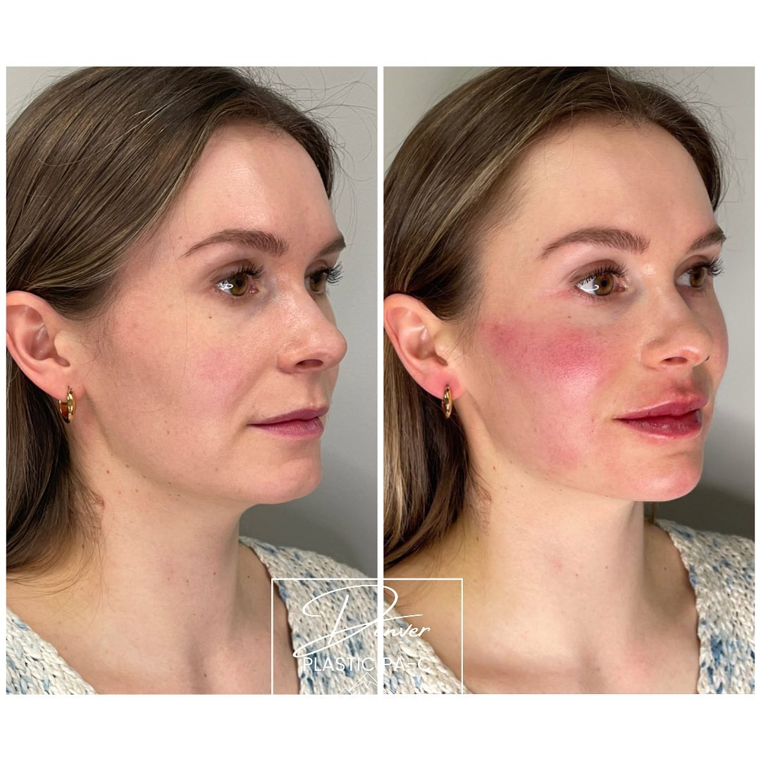 Patient 60780835 Jawline Sculpting Before & After Photos Peak